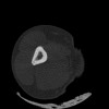 SPORK, NICO - 22.03.1976 - 02.08.2022 - CT obere Extremität - 17:51:17